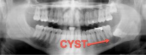 dental x-ray taken by Sugar Land, TX area Prosthodontists and Dentist, Dr. Stuart Rimes. The x-ray shows a cyst that had to be removed.