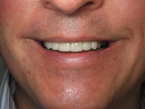 Dental Proceedures make you look younger - After photo of Sugar Land Dentist, Stuar Rimes, dental procedure